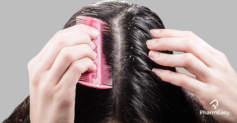 The Role of Stress in Dandruff Flare-Ups: Managing Your Mane and Mind
