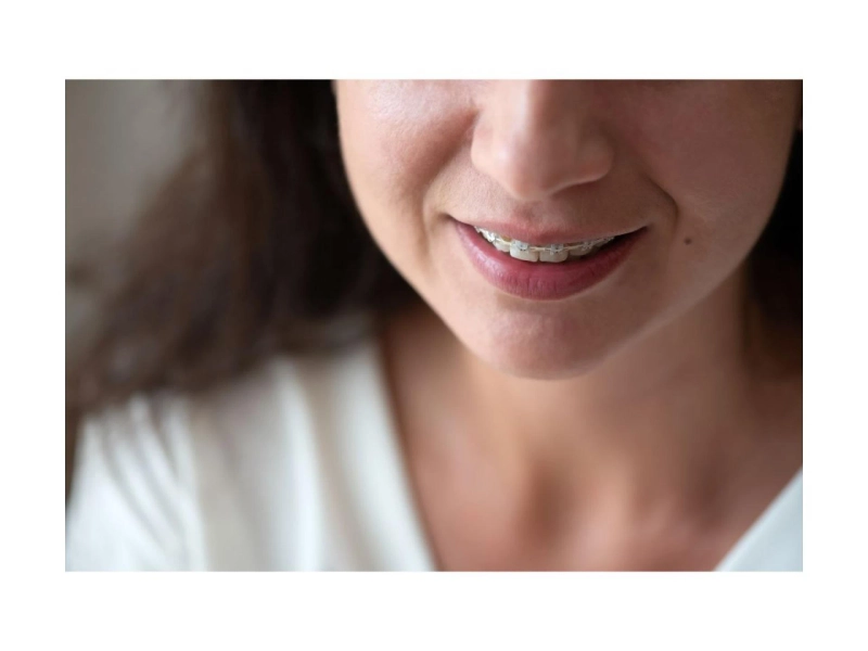 Why Teens in Parkway Forest Choose Invisalign