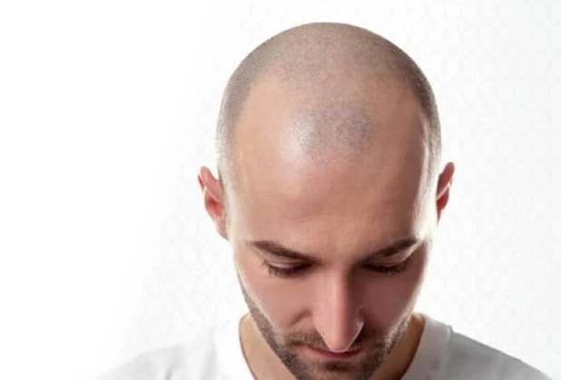 Hair Transplant: The Permanent Solution for Hair Loss