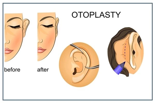 Otoplasty Surgery: Procedure and Benefits