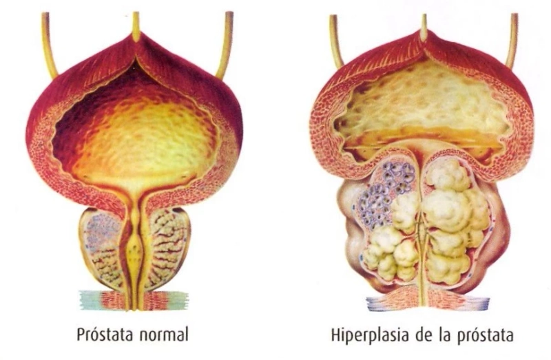 Prostatit kesin tedavisi