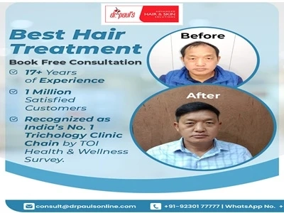 Regaining Confidence Through Advanced Hair Solutions in Kolkata