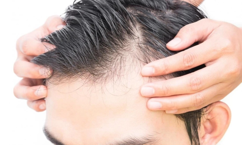 Questions To Be Asked in Primary Consultation Before Hair Transplant?