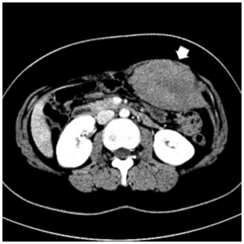 Desmoid Tumors Can Be Diagnosed By Physical Examination, Imaging Scans, And Biopsies