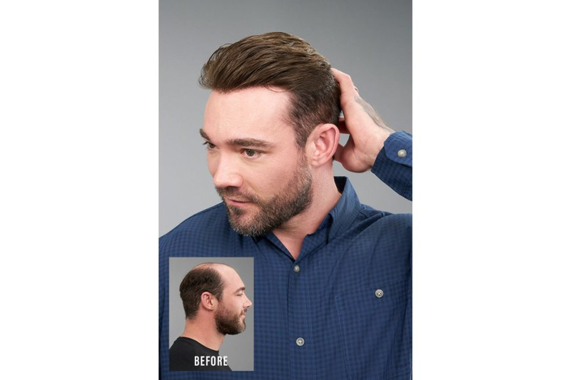 10 Signs You Should Visit a Hair Replacement Specialist
