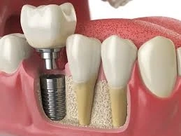 Dental Implant Procedure Step-by-Step: What Patients Should Know
