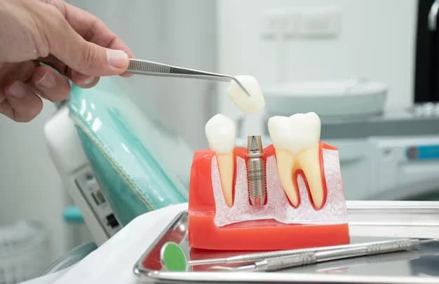 Missing Teeth? Discover the Benefits of Cardiff Dental Implants