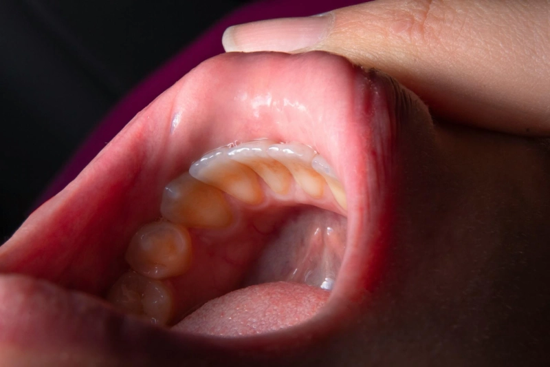 Swelling After Tooth Extraction: How Long Does It Last?