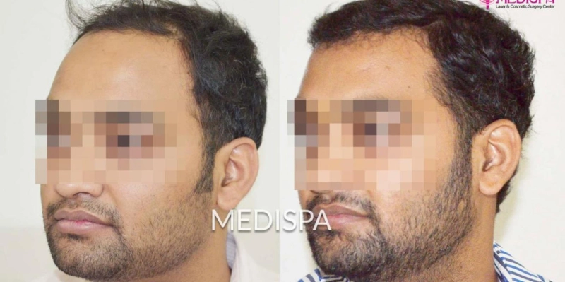 Hair Transplant a single Option for Restoring the Hair
