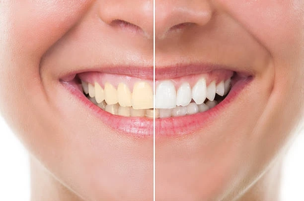A Comprehensive Guide to Teeth Whitening Treatments