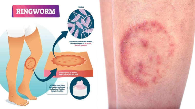 Ringworm in Athletes: Managing Infections and Preventing Spread in Sports