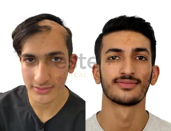 What to Expect: FUE Hair Transplant Before and After Journey