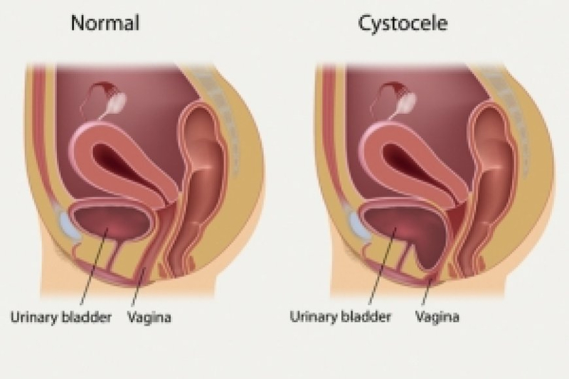 Understanding Cystocele Surgery Success Rates: A Comprehensive Overview