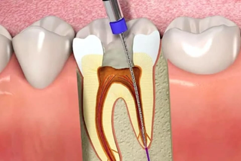 Signs You Need to Visit an Experienced Endodontist in Hinjewadi
