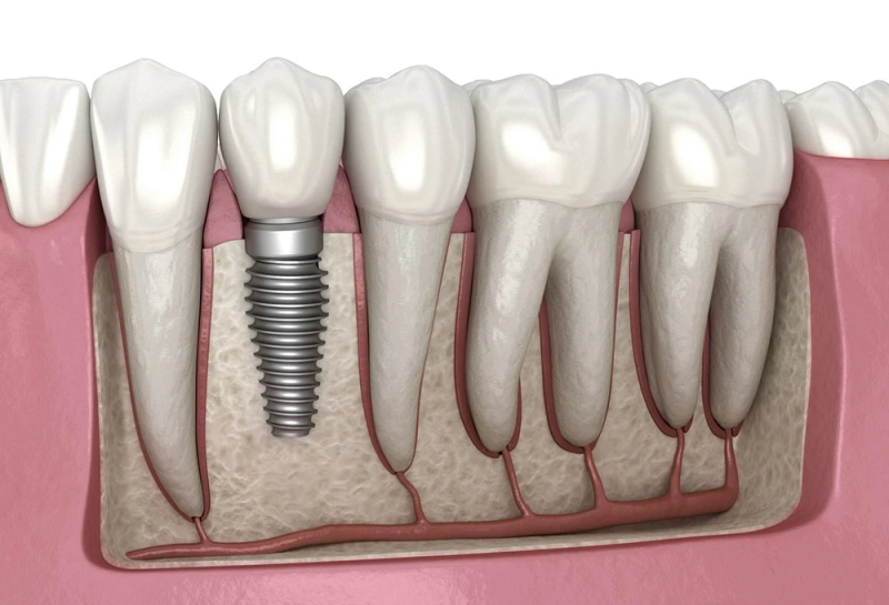 United States Dental Implants Market to Grow with a Double Digit CAGR until 2027