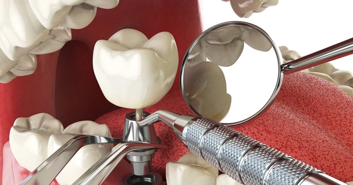 Understanding Advanced Dental Solutions for Long-Term Oral Health