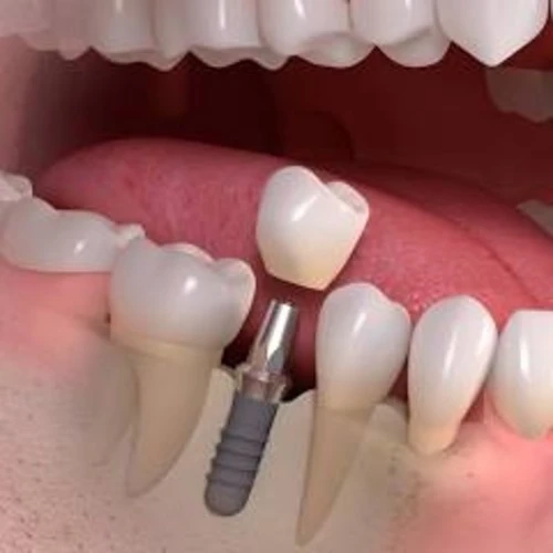 Dentist Elanora Height for Gentle Family Dental Care