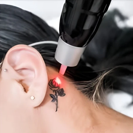 Laser Tattoo Removal in Windham, NH: Your Guide to Safe, Effective Treatment