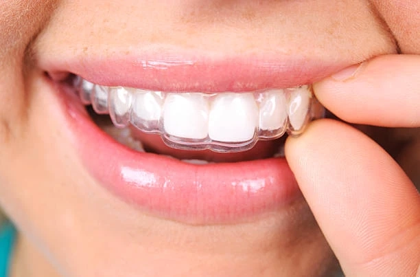 A Modern Path to a Confident Smile: Your Guide to Invisalign in Dana Point