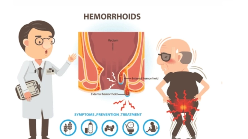 How to Avoid Infection After Hemorrhoid Surgery?
