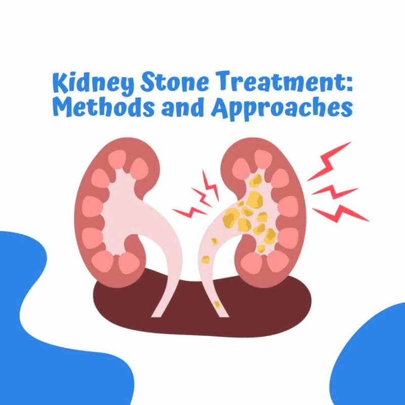 Comprehensive Guide to Kidney Stone Treatment: Methods and Approaches