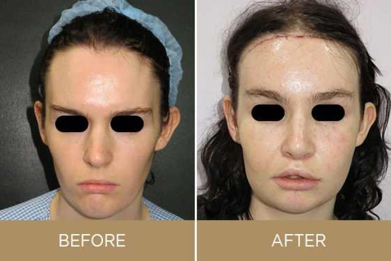 Why is Cheek Augmentation Needed in Facial Feminization?