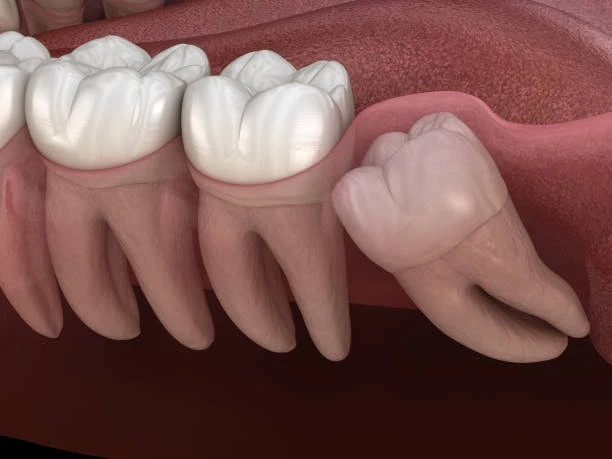 What Your Mouth Might Be Telling You About Impacted Wisdom TeethMy Post Title