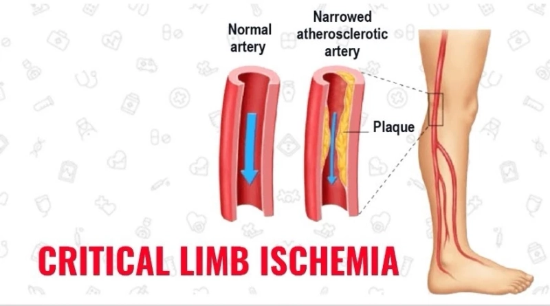 Chronic Limb Ischemia: Symptoms, Diagnosis and Treatment