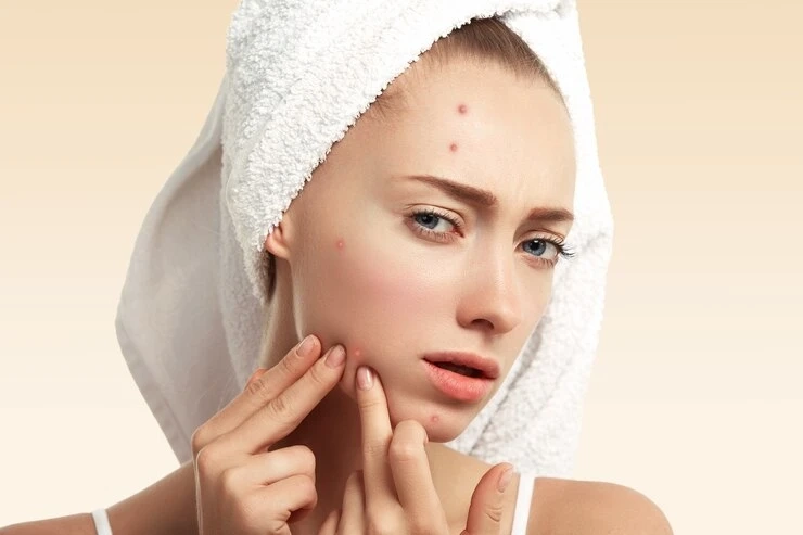 Differin Gel: What to Know About This OTC Acne Treatment?