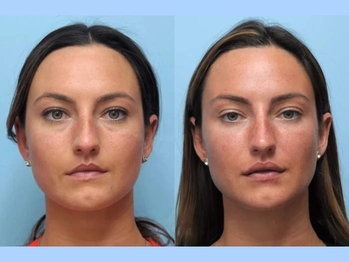 Real Results with the Best Plastic Surgeon in Dubai for Thread Lift