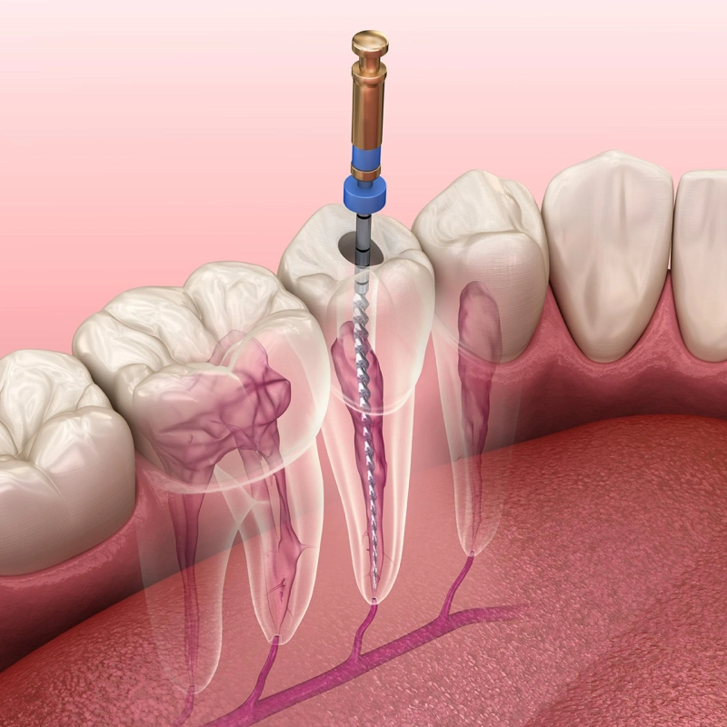 How to Confirm a Root Canal Infection