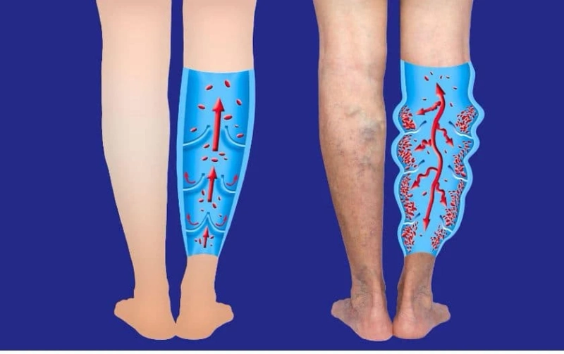 Vein Care and COVID-19