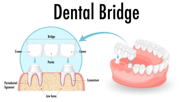 Different Types of Dental Bridges Explained