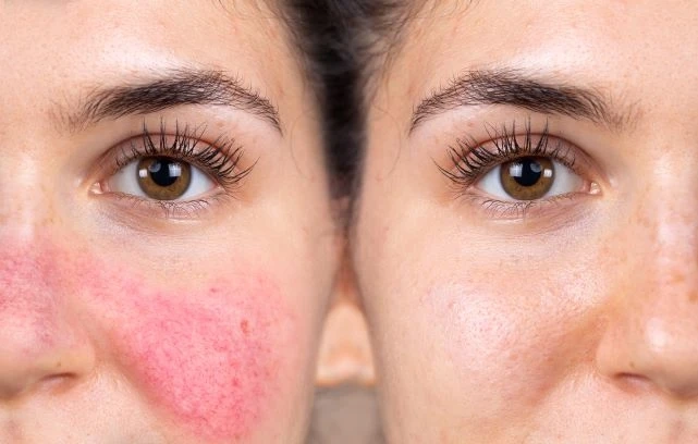 How Laser Treatments for Rosacea Can Reduce Redness and Visible Blood Vessels