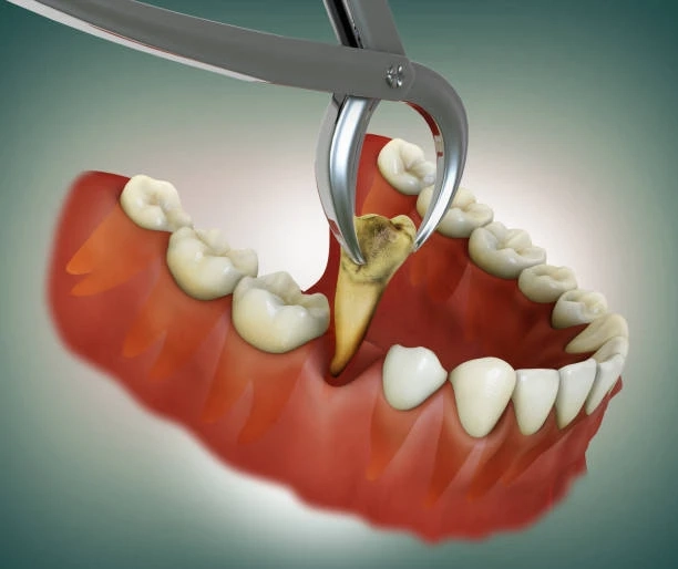 Preserving Oral Health with Precision: What You Should Know About Root Canal in Santa Clarita
