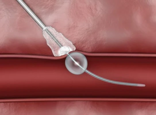 Vascular Closure Devices Market - Global Industry Analysis by Size, Share and Forecast 2022 – 2027