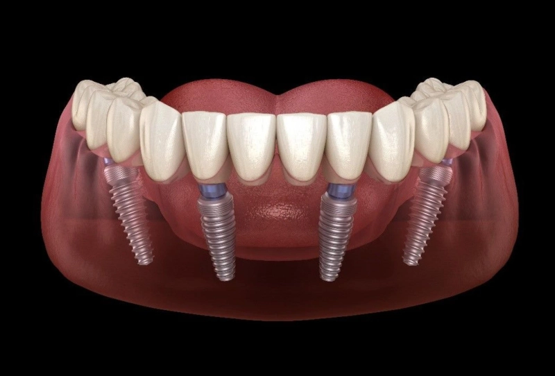 Dental Implants: An Affordable, Natural Way of Replacing Missing Teeth.