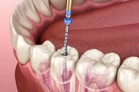 Understanding the Difference Between Root Canal Treatment and Teeth Bleaching