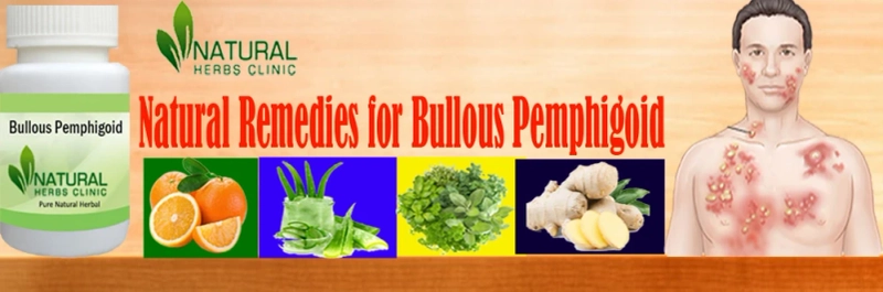 Natural Remedies for Bullous Pemphigoid to Fight the Symptoms