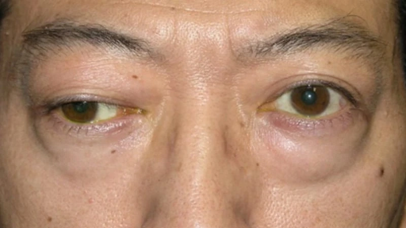 Myasthenia Gravis Market: Industry Analysis, Opportunity and Forecast to 2027