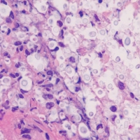 The Future of Cryptococcosis Treatment: Advancements in Research and Development