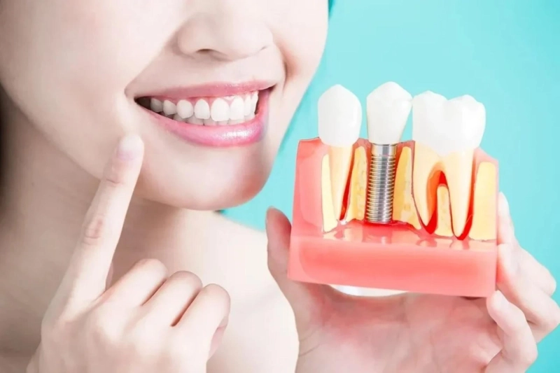 Top 7 Benefits of Getting the Best Dental Implants in Mississauga