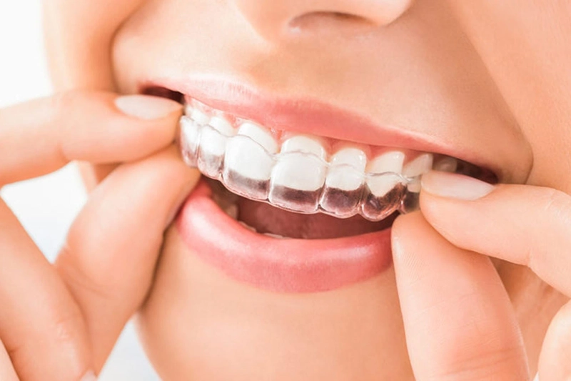 How to Choose the Right Teeth Aligners for Your Needs?