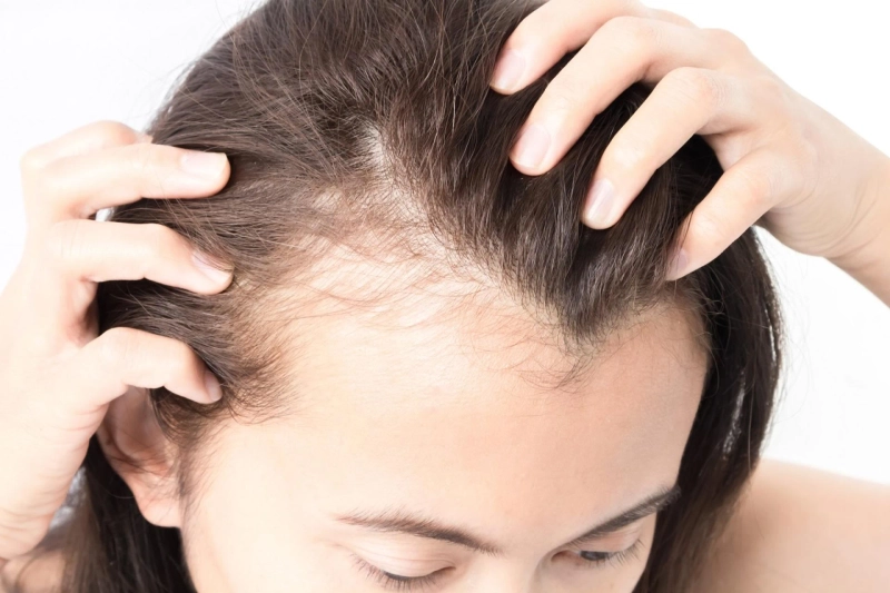 Forecasting 2022-2028: Global Hair Loss Treatment Market trends, share, size, growth, opportunities, and forecasts