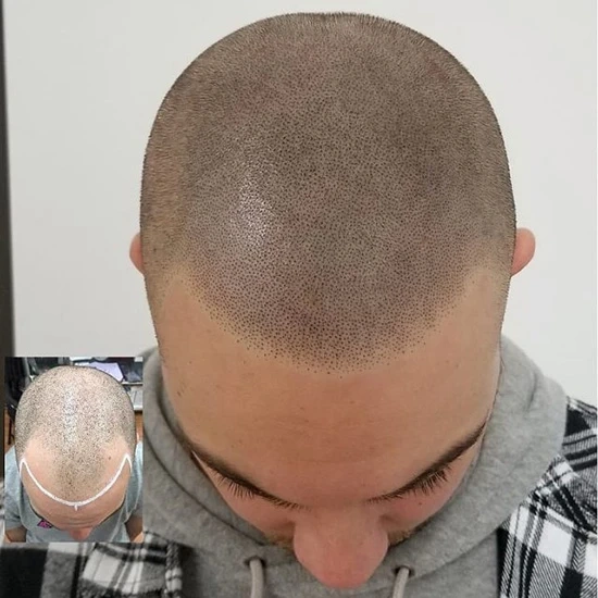 Micro scalp pigmentation - Brow contour