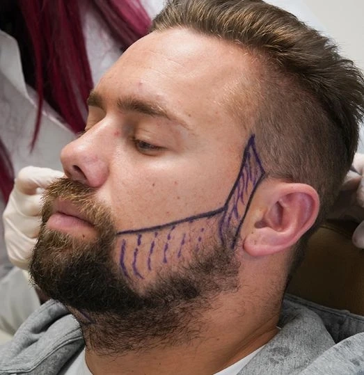 Beard Transplants in London: Everything You Need to Know
