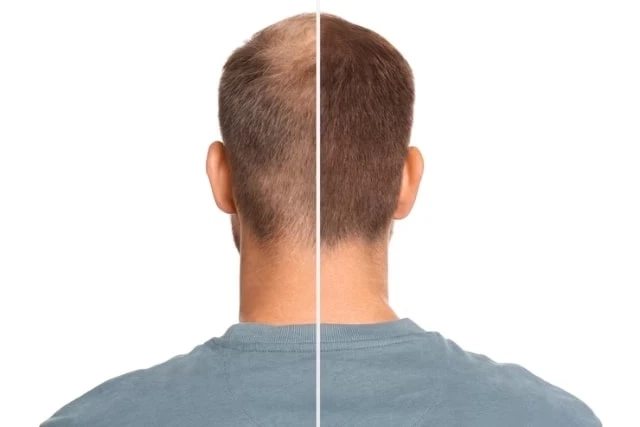 Discover Comprehensive Hair Loss Solutions at Aayna Clinic, Delhi
