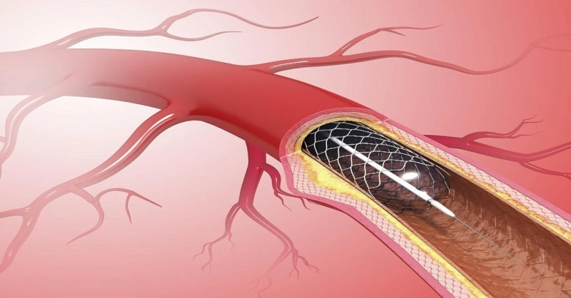Expandable metal mesh Coronary Stents are improving percutaneous coronary revascularization outcomes