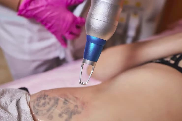 Laser Tattoo Removal Treatments to Try in Cheshire