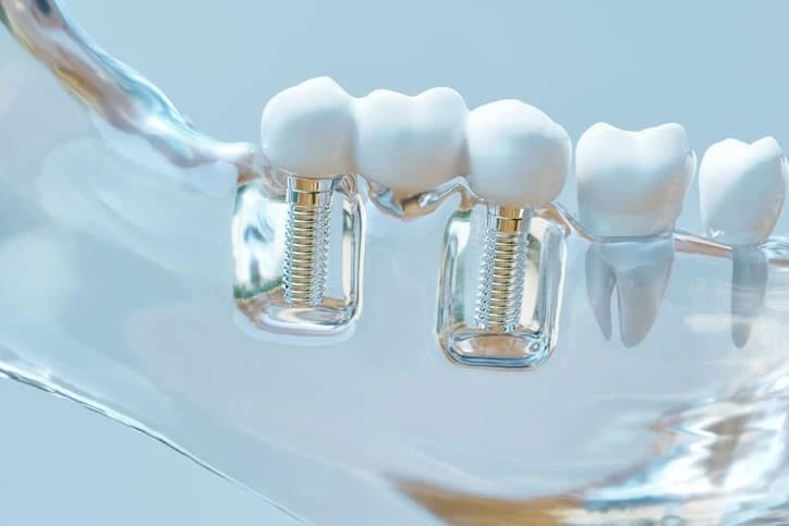 Dental Crowns - Benefits and Disadvantages